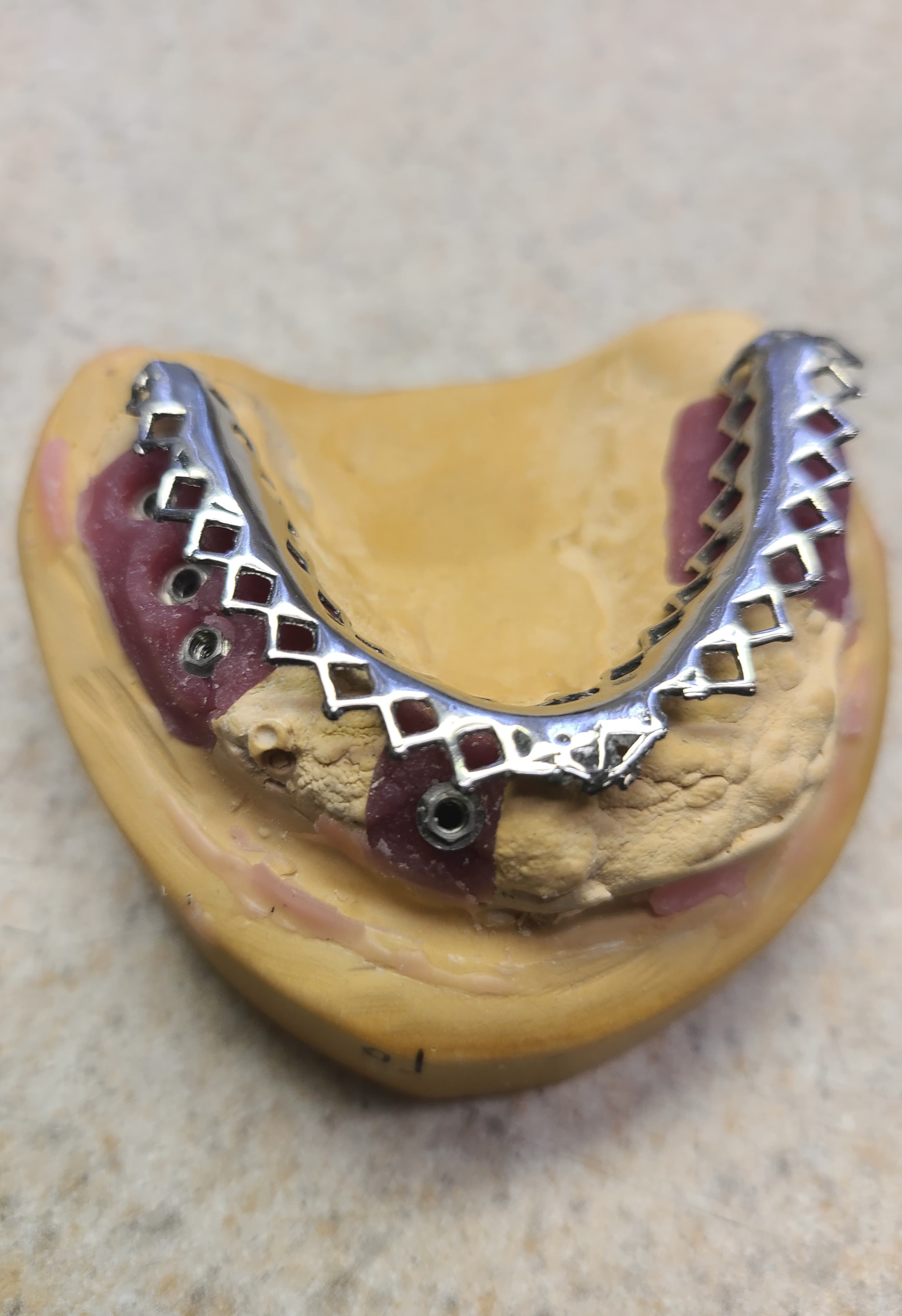 Full-Arch Immediate Load Rehabilitation