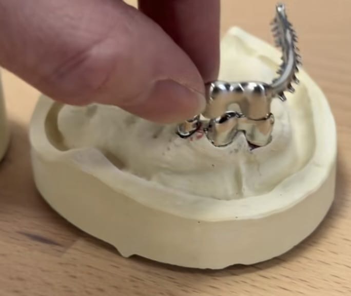 Multiple Full-Arch Restoration